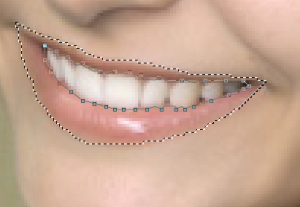 Обводка зубов